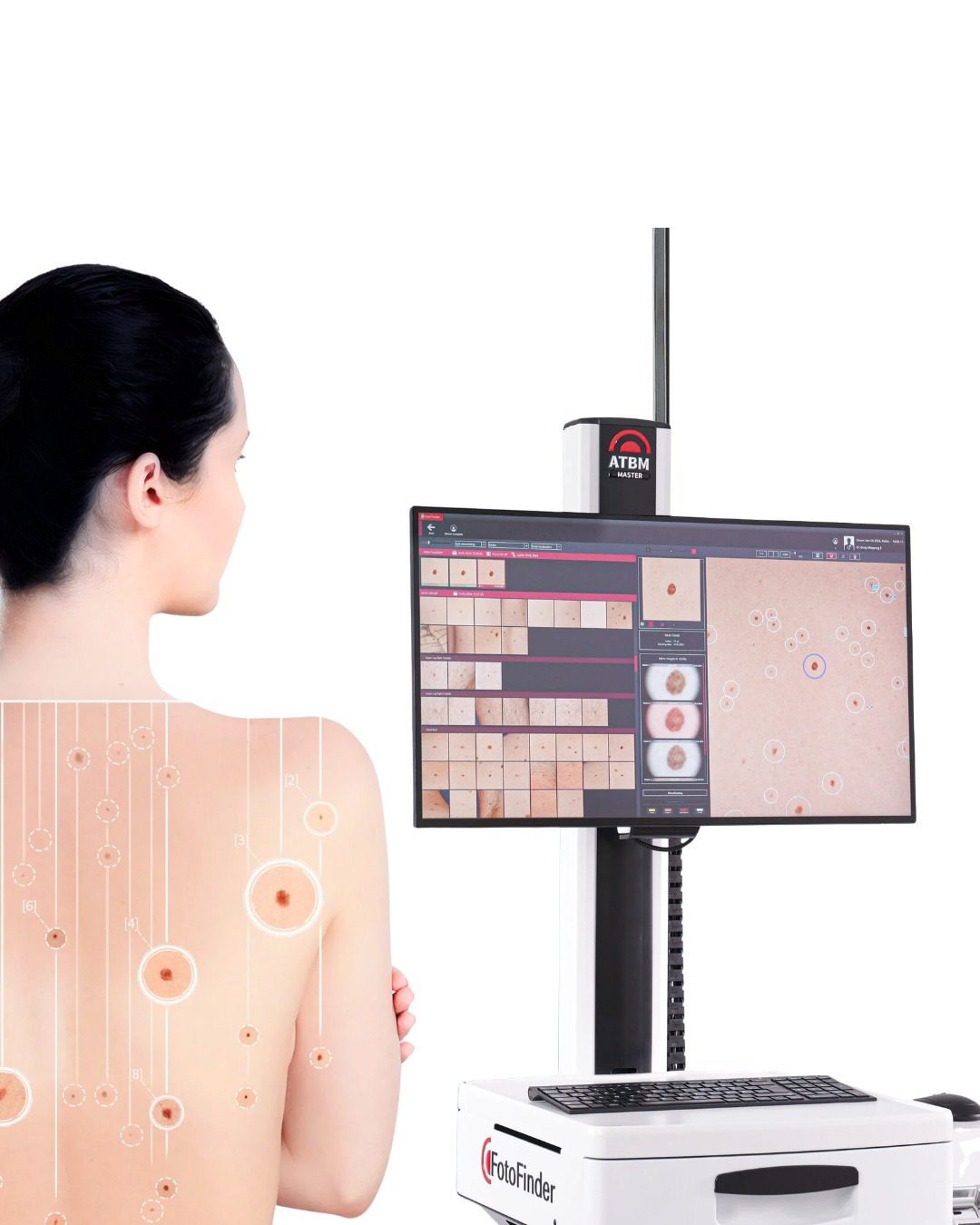 Dermatoscopie &amp; monitorizare alunițe