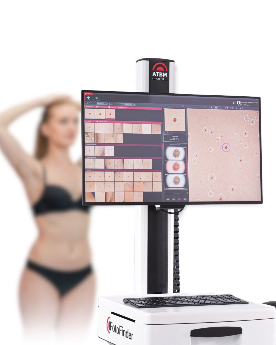 Dermatoscopie &amp; monitorizare alunițe