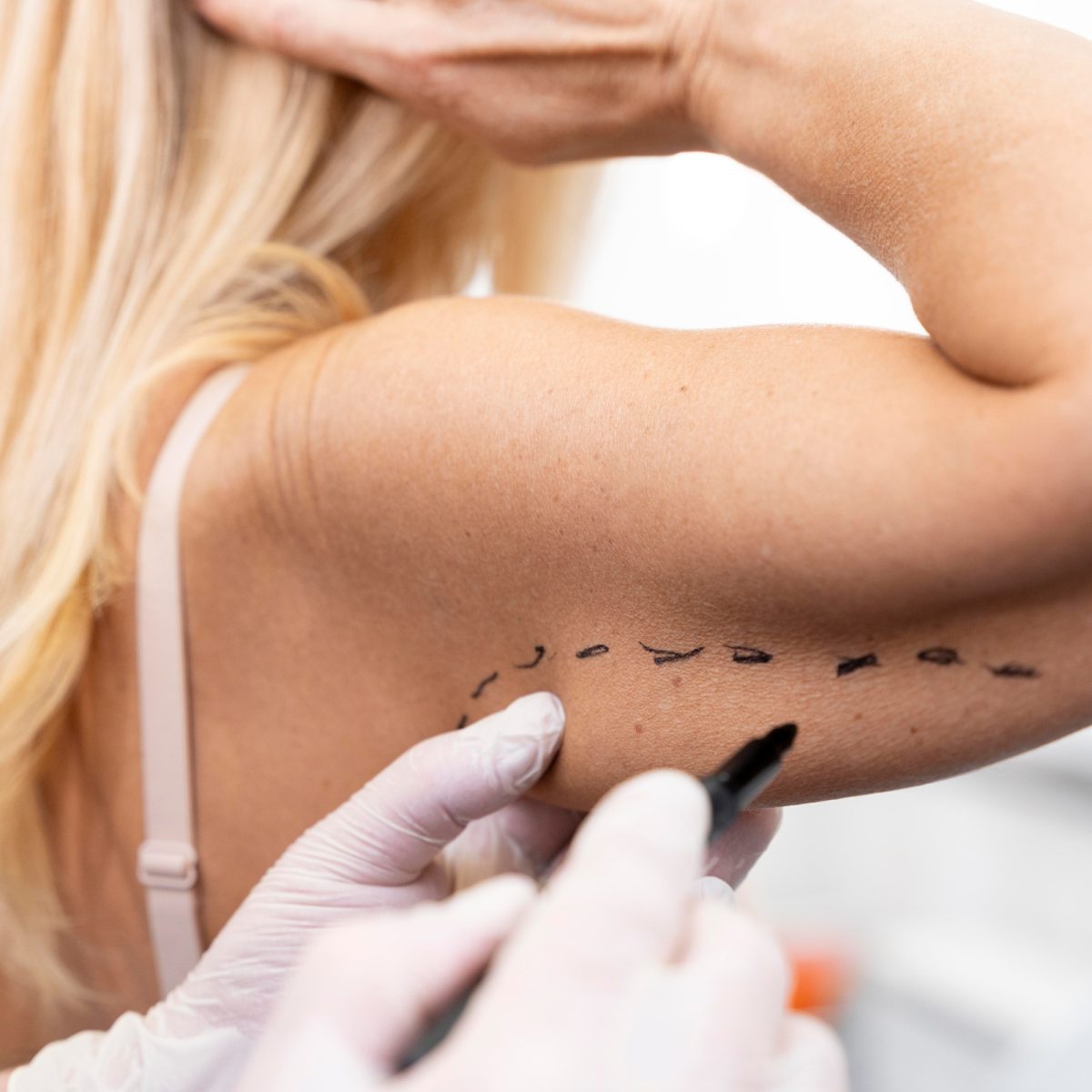 Chirurgie dermatologică