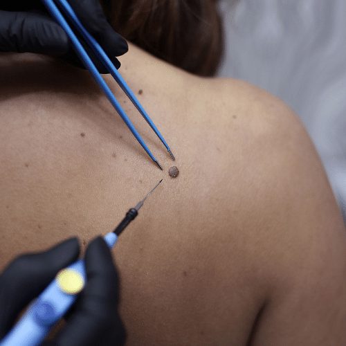 Electrocauterizări și tratamente cu laser CO₂
