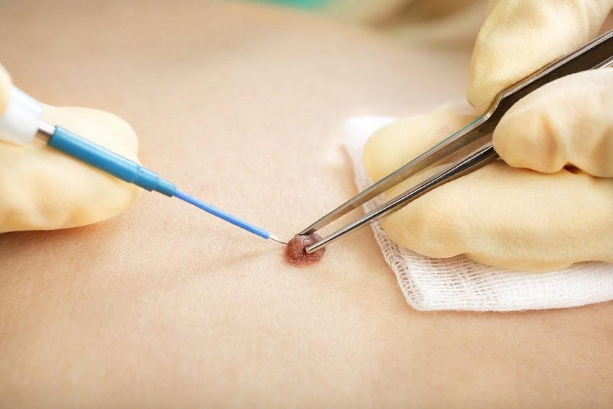 Electrocauterizări și tratamente cu laser CO₂