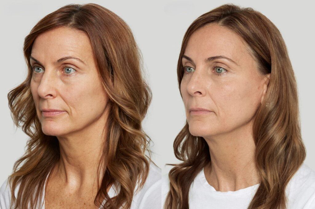 Sculptra (biostimulator de colagen) - rezultatele care cresc în timp