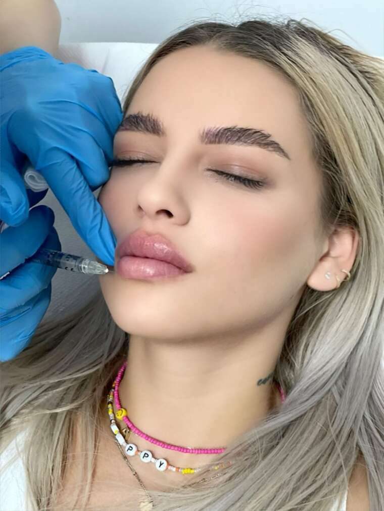 Augmentarea buzelor cu acid hialuronic - ghidul meu pentru rezultate naturale