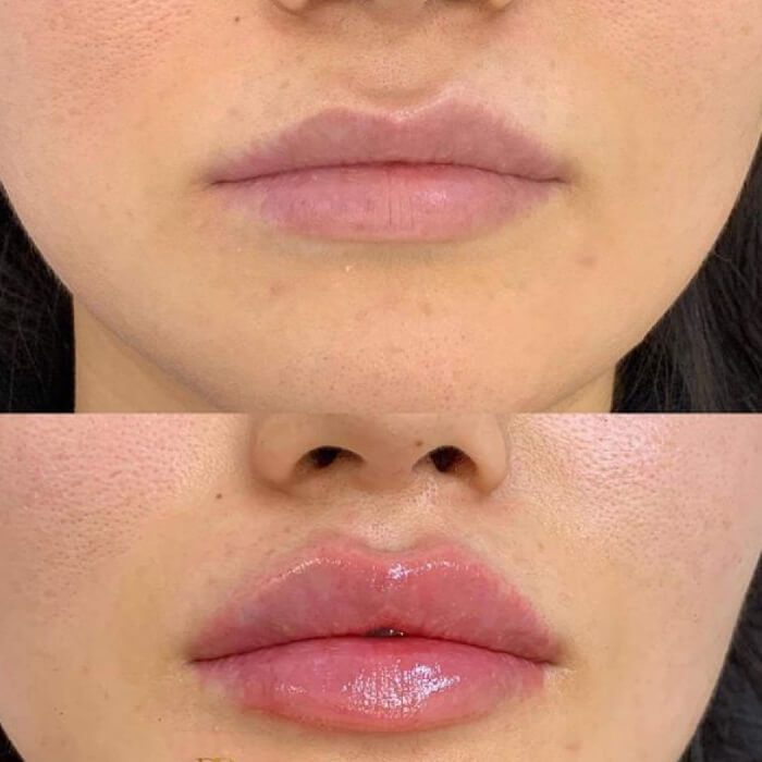 10 mituri despre acidul hialuronic